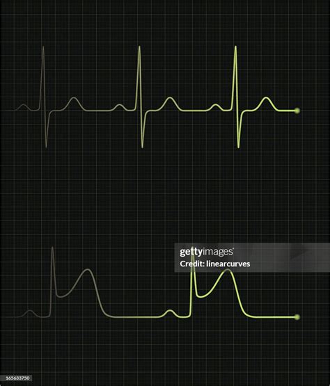 Image result for Normal vs Abnormal ECG