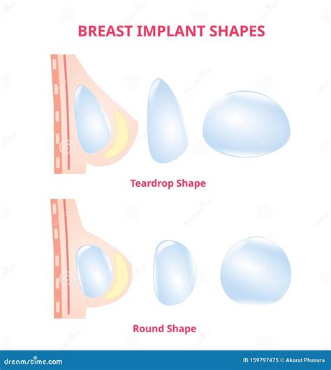 Breast Implant Silicone Compare Round and Tear Drop, Breast Surgery ...