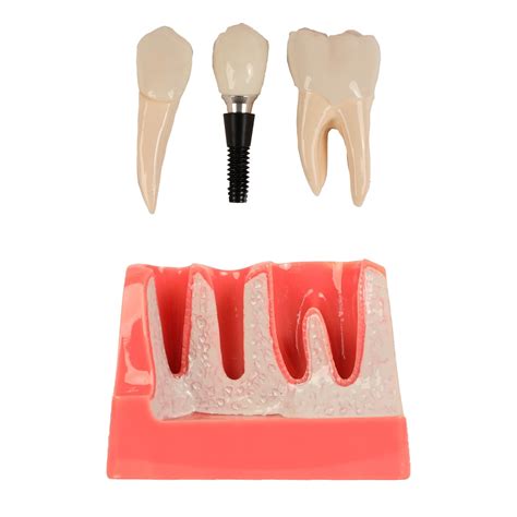 Buy Axis Scientific Enlarged Dental Implant Anatomy Model Online at ...