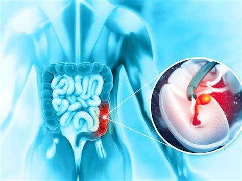 Rising cases under 50: Colon cancer myths that mislead patients and ...