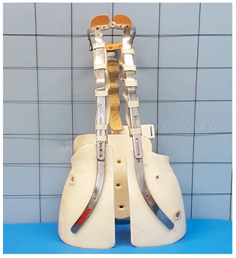 Temporomandibular Joint Disorders in Females with Adolescent Idiopathic ...