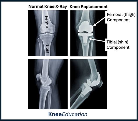 Percentage Of Knee Replacements With Problems