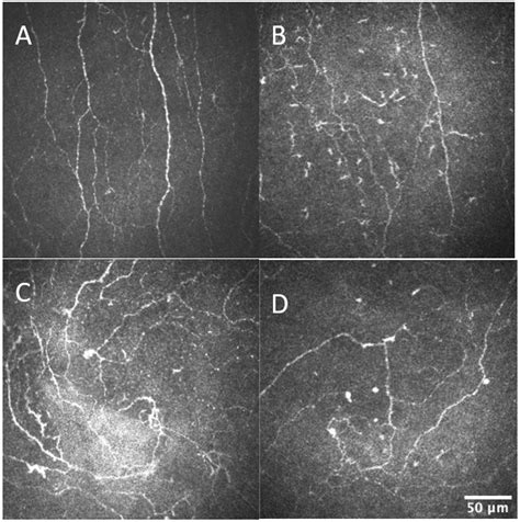 Chronic Kidney Disease Has No Impact on Tear Film Substance P ...