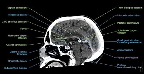 Image result for Normal Brain CT Scan Head