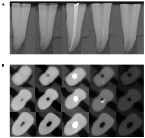 Retreatability of Bioceramic-Filled Teeth: Comparative Analysis of ...