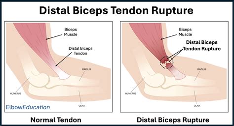 Distal Biceps Tendon Rupture - Elbow Education