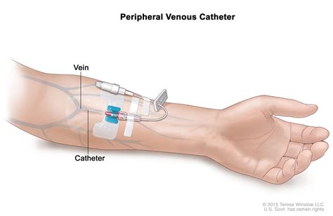 Two Types Of Peripheral Venous Access Device at Odessa Francis blog