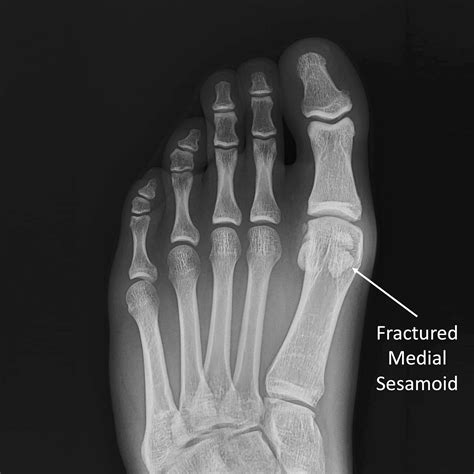 Sesamoid Bone X Ray