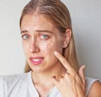 Which homeopathic medicine should we use for skin allergy?