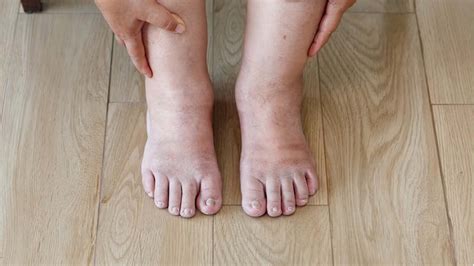 What Can Cause Swelling in Hands and Feet? – NutritionFact.in