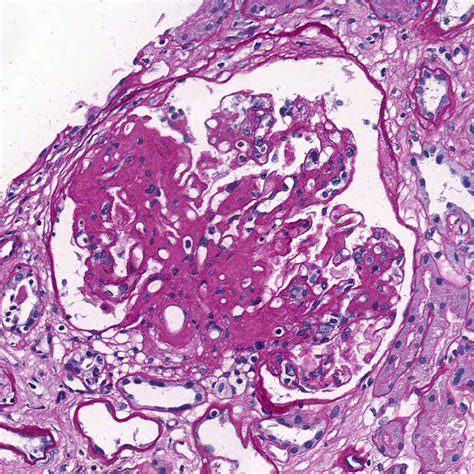 Glomerulosclerosis And Interstitial Fibrosis Pathology Outlines - Scleroderma renal disease