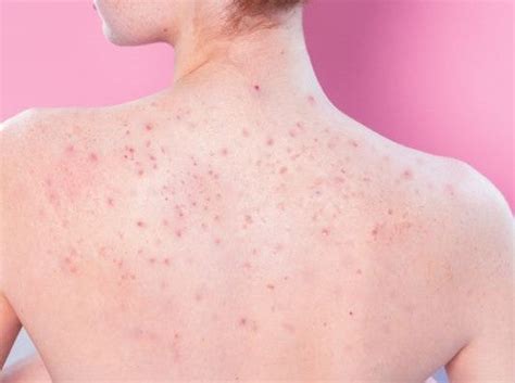 Exploding Bacne 的图像结果