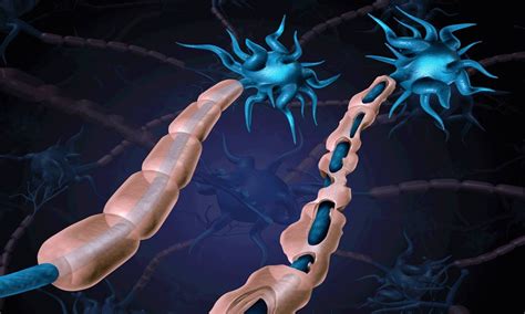 World Multiple Sclerosis Day 2021: Here is an explainer into this auto ...