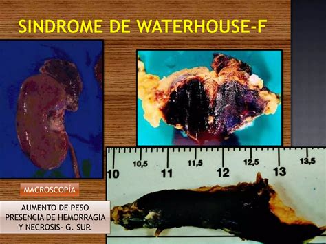 Sindrome Waterhouse Friderichsen