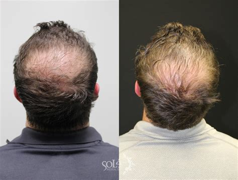 PRP Hair Loss Therapy for Tifton, Albany, and Valdosta, GA