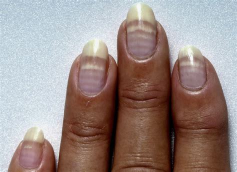 White Lines On Nails Pictures at Phoebe Reddall blog