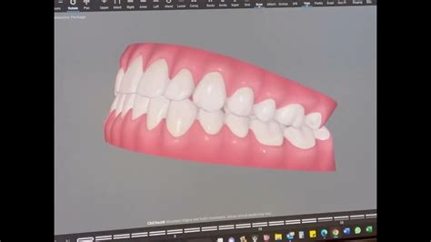 Invisalign Animation 的图像结果