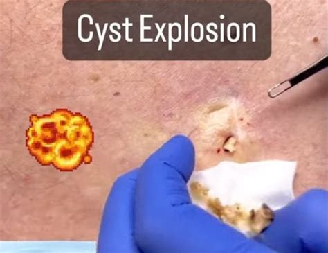 Image result for Exploding Cyst Cheese