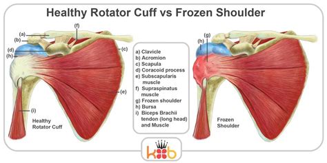 Some Background Guidance On Quick Systems In Frozen Shoulder Injection