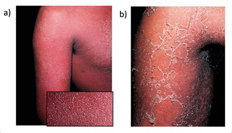 Vom Exanthem bis zum TEN – die neuen Tabletten sind schuld ...