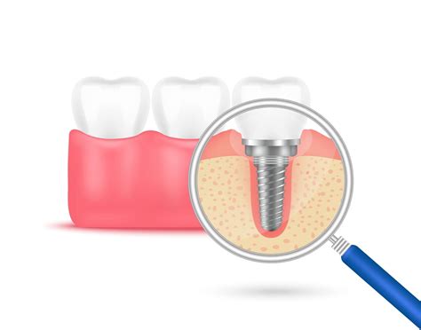 Different Types of Dental Implants and Their Indications | Savannah, GA ...