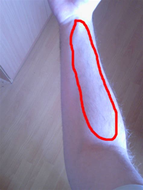 Forearm pain during and after cycling - Bicycles Stack Exchange