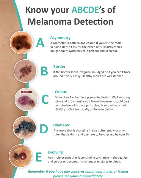 Melanoma Vs Freckle at Matthew Wetzel blog
