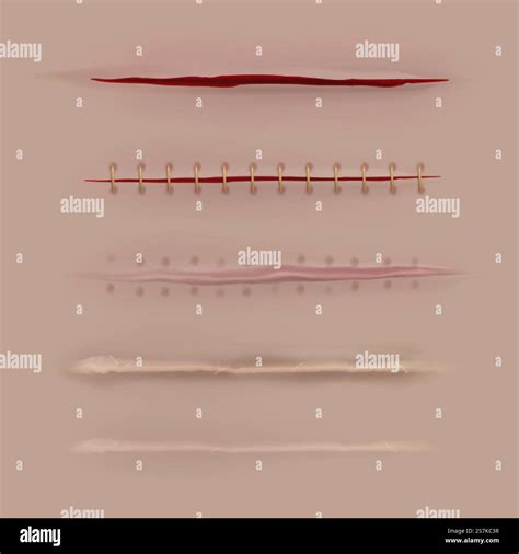 Surgical sutures healing stages. Realistic bloody wound and stitch closeup texture. Scars ...