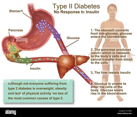 llustration of insulin and glucose production in Type 2 diabetes. Insulin is produced by islet ...