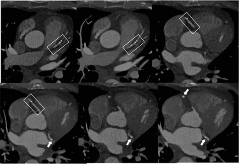 Coronary Artery Calcification: Current Concepts and Clinical ...