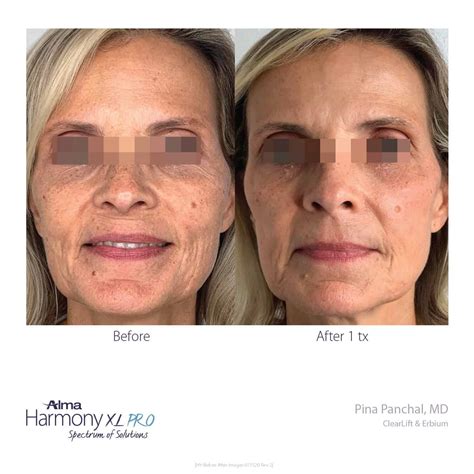 Pixel Erbium laser Skin Resurfacing - MIYA Aesthetics & Wellness