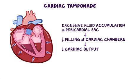 Difference Between Pericarditis And Cardiac Tamponade – WATQVT