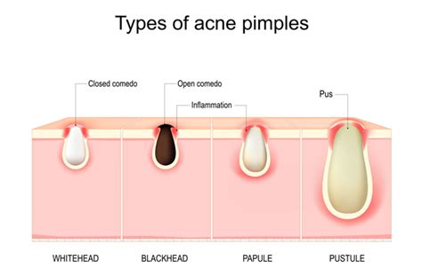 Hormonal Acne Causes Types Treatment and Prevention | Blue Nectar