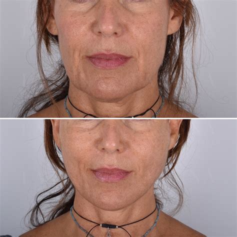 Threading Facelift Before and After 的图像结果