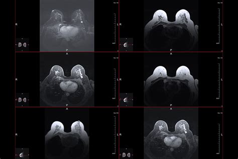 What Does Breast Cancer Look Like In Mri at Matilda Fraser blog