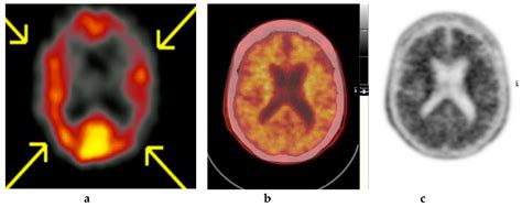 The Who, When, Why, and How of PET Amyloid Imaging in Management of ...