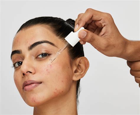 Treating Genetic or Hormonal Acne | Novology – Novology India