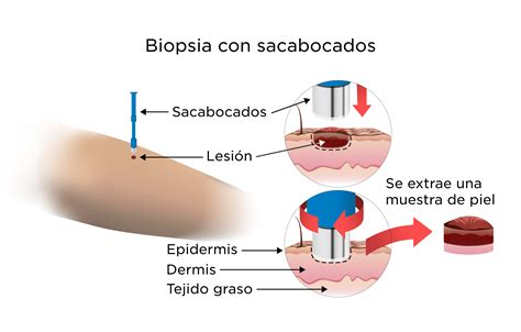 Que Es Una Biopsia