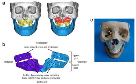 Surface Topography-Based Positioning Accuracy of Maxillary Templates ...