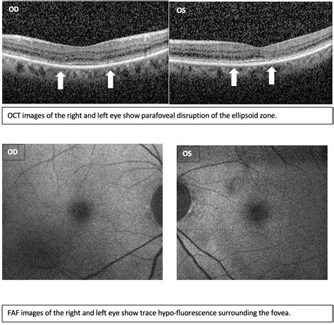 Asymptomatic and Early Hydroxychloroquine Retinal Toxicity | Colorado Retina