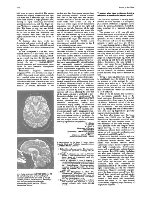 Image result for Alien Arm Syndrome