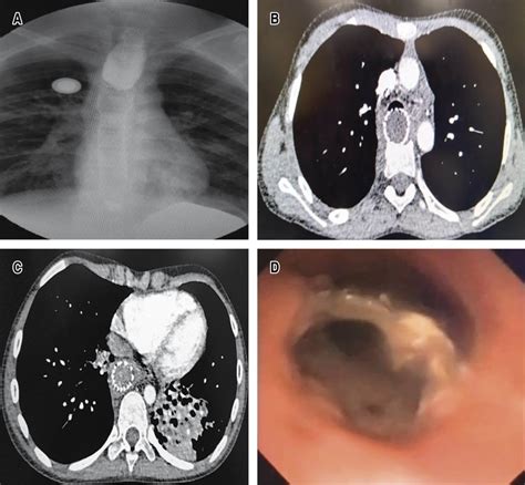 Severe tracheo-esophageal fistula induced by stent: repair by membranous tracheoplasty with ...