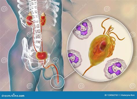 Trichomoniasis Infection in Man Stock Illustration - Illustration of ...