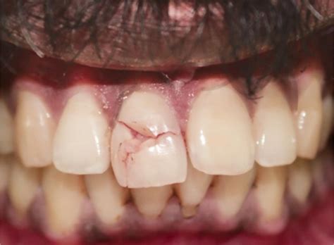Multidisciplinary Management of Anterior Traumatized Tooth: A Case Report