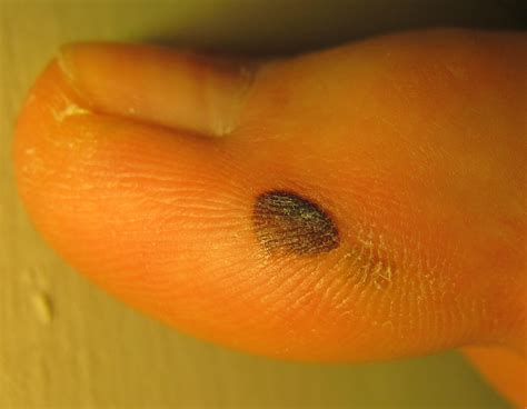 Black spot appeared on big toe two months ago. : r/Melanoma