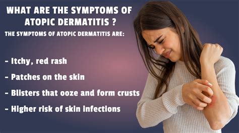 atopic dermatitis treatment | symptoms of atopic dermatitis | What ...