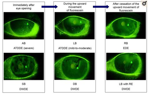 Evaporative Dry Eye Disease at James Aviles blog