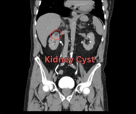 Image result for What Is a CD Urogram Scan Procedure