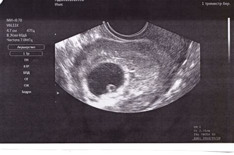 Ecografía a las 8 semanas de gestación (20 fotos): tamaño fetal y tasa pélvica, que muestra una ...