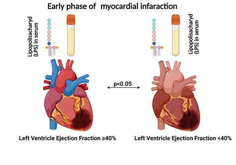 Serum Zonulin and Lipopolysaccharide (LPS) Levels in Early Myocardial ...